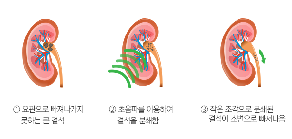 체외충격파쇄석술 치료과정